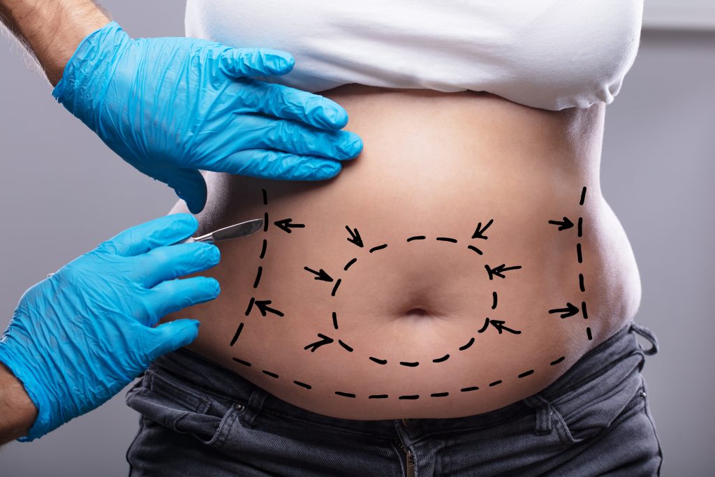 liposukcja strzykawkowa w Olsztynie