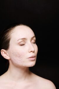 Jak należy się przygotować do peelingu głębokiego