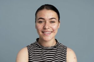 Trądzik u dorosłych