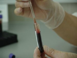 Zabiegi z wykorzystaniem toksyny botulinowej na nadmierną potliwość